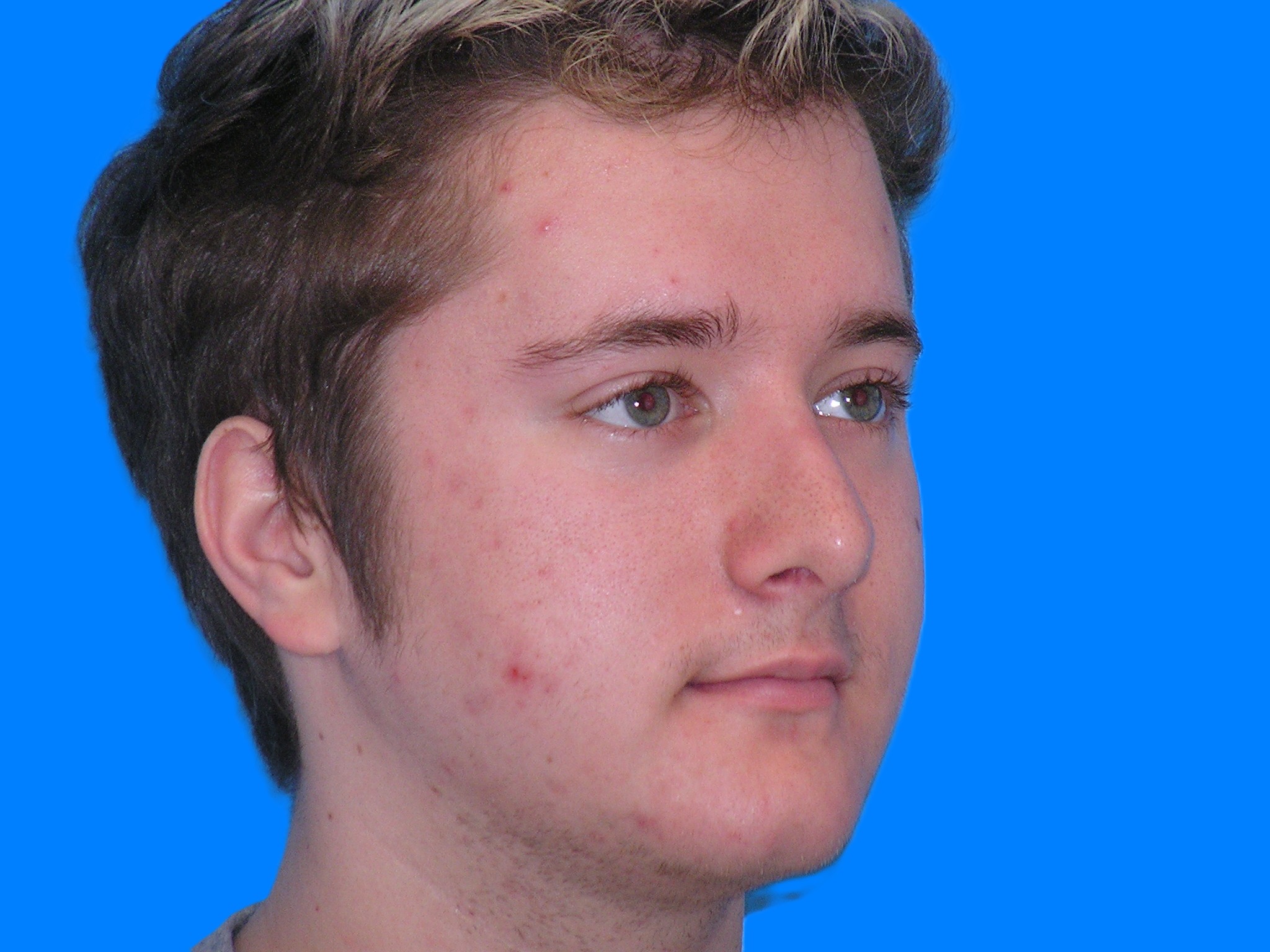 After Image: Patient Case #1404 - right-front-oblique