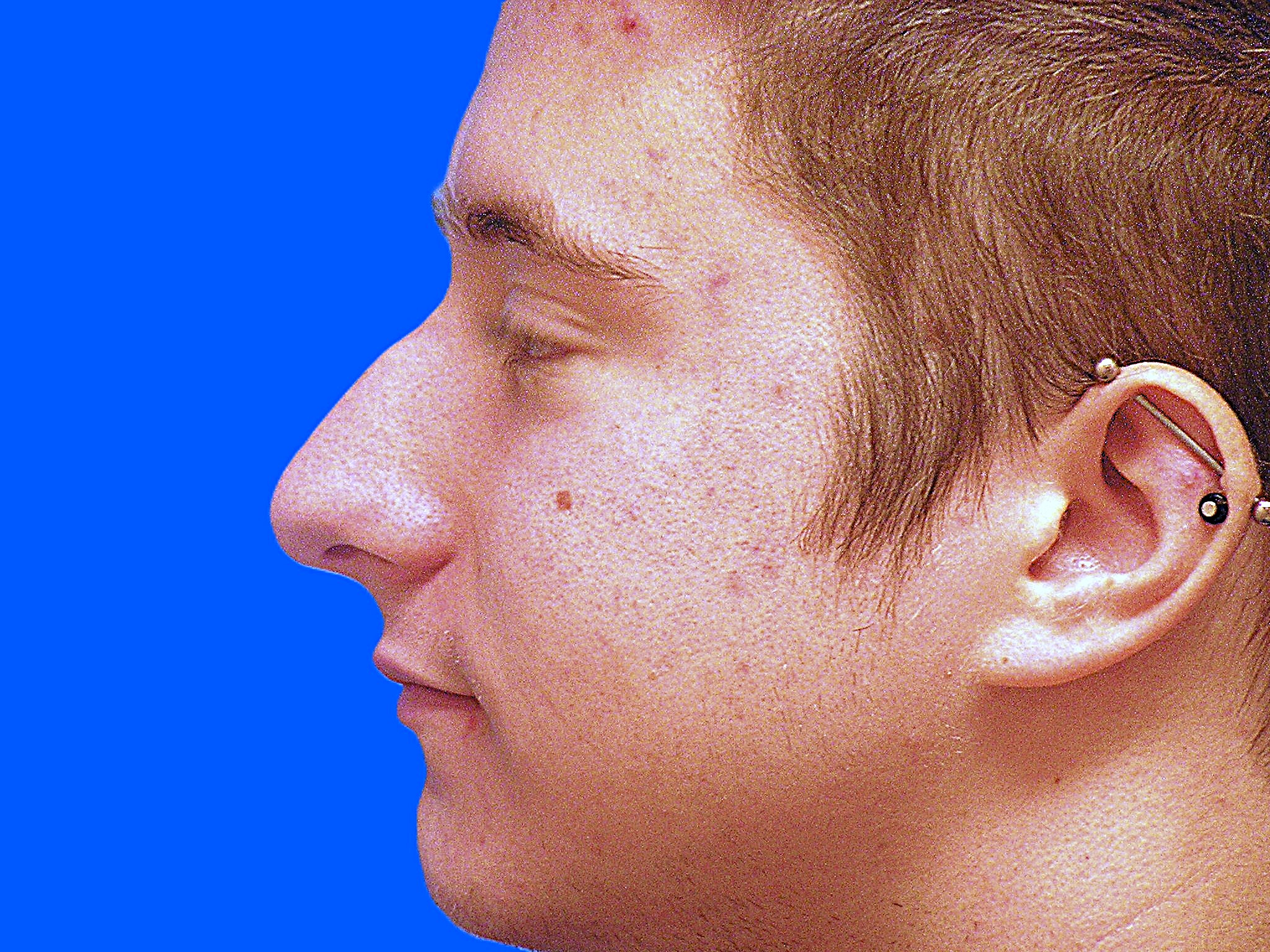 Before Image: Patient Case #1404 - left-side