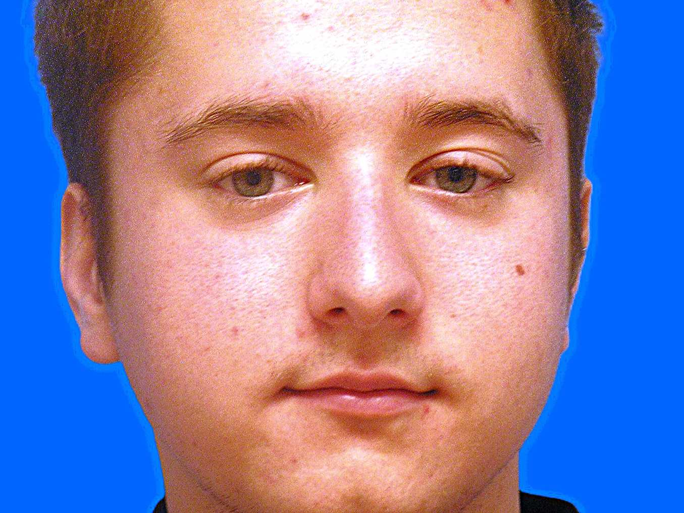 Before Image: Patient Case #1404 - front