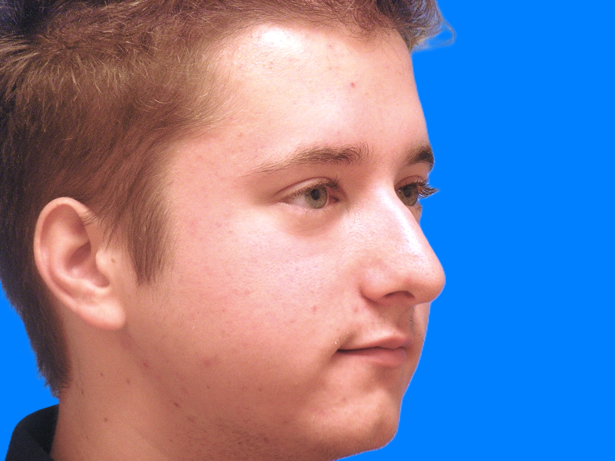 Before Image: Patient Case #1404 - right-front-oblique