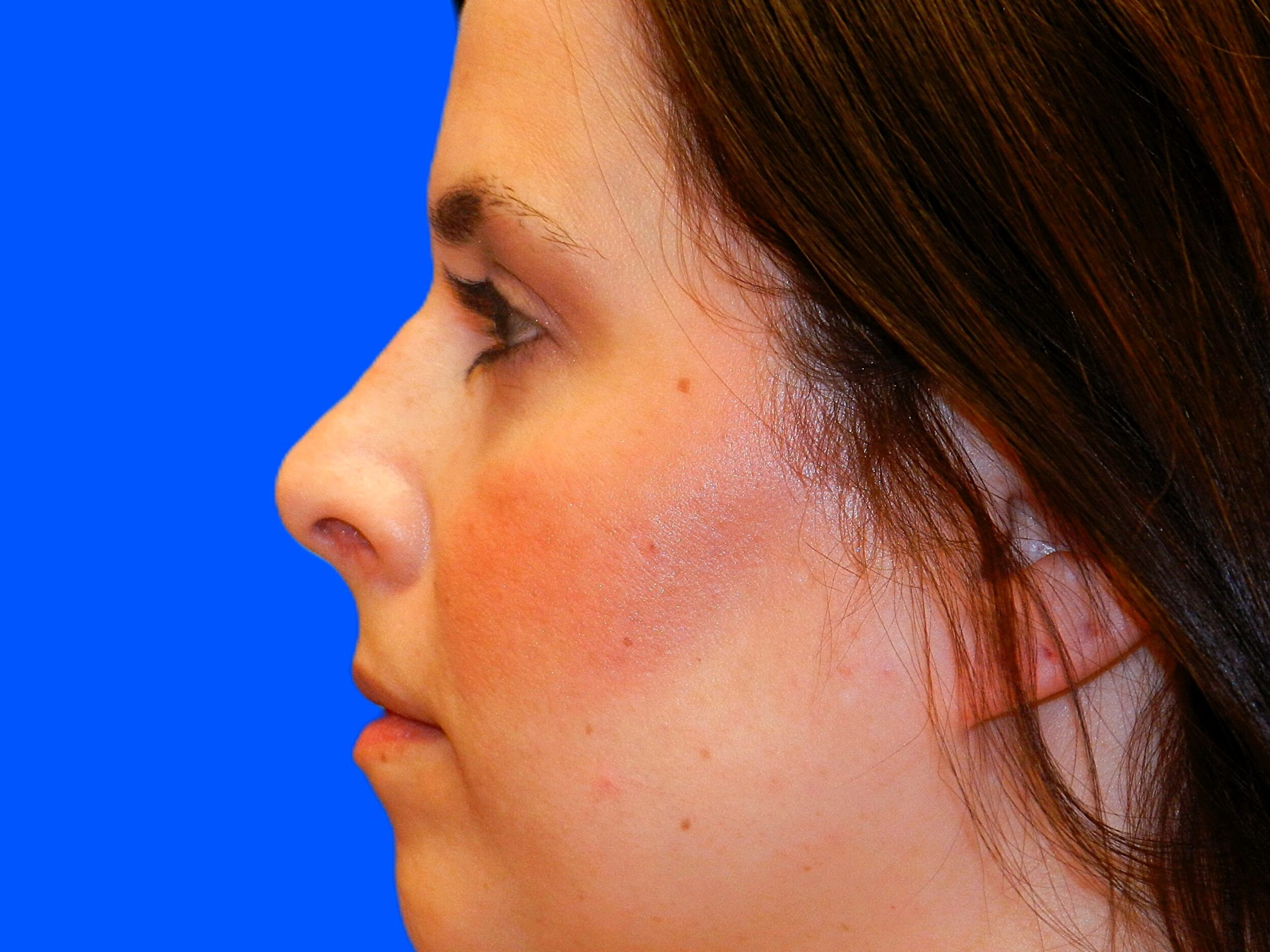 After Image: Patient Case #1405 - left-side