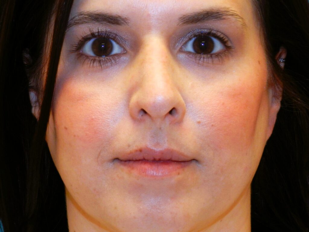 After Image: Patient Case #1405 - front