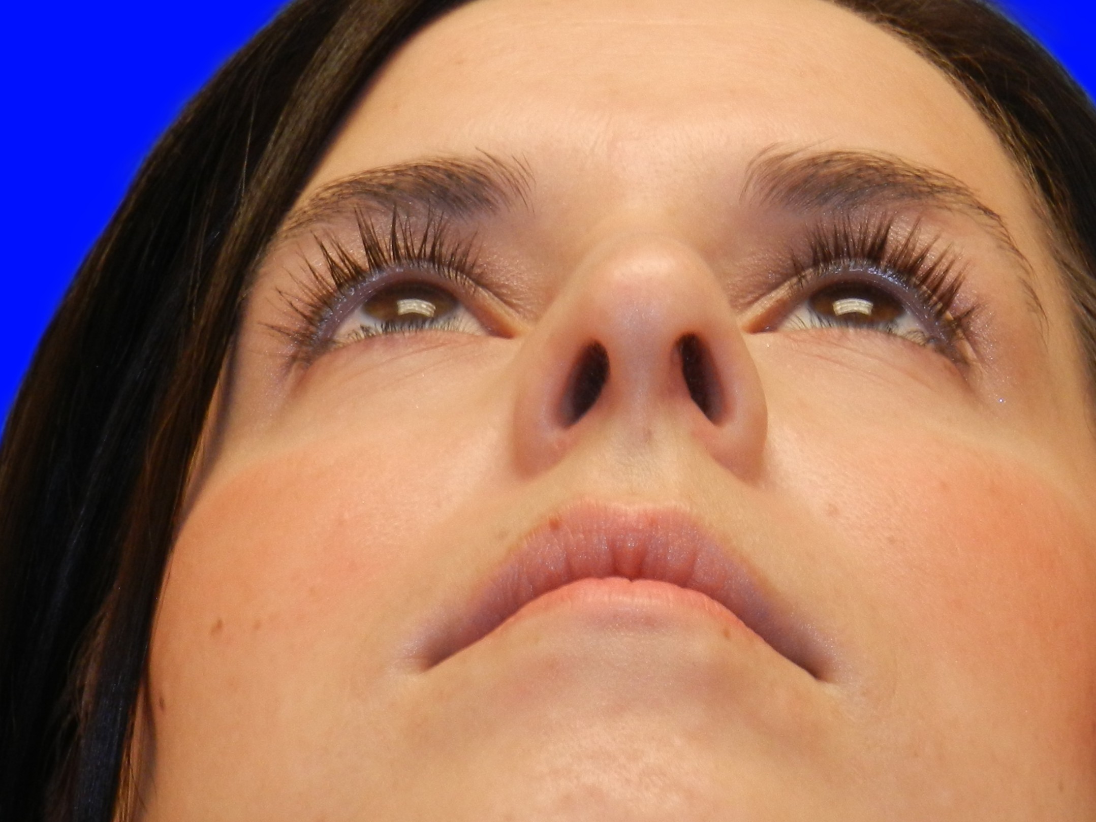 After Image: Patient Case #1405 - front