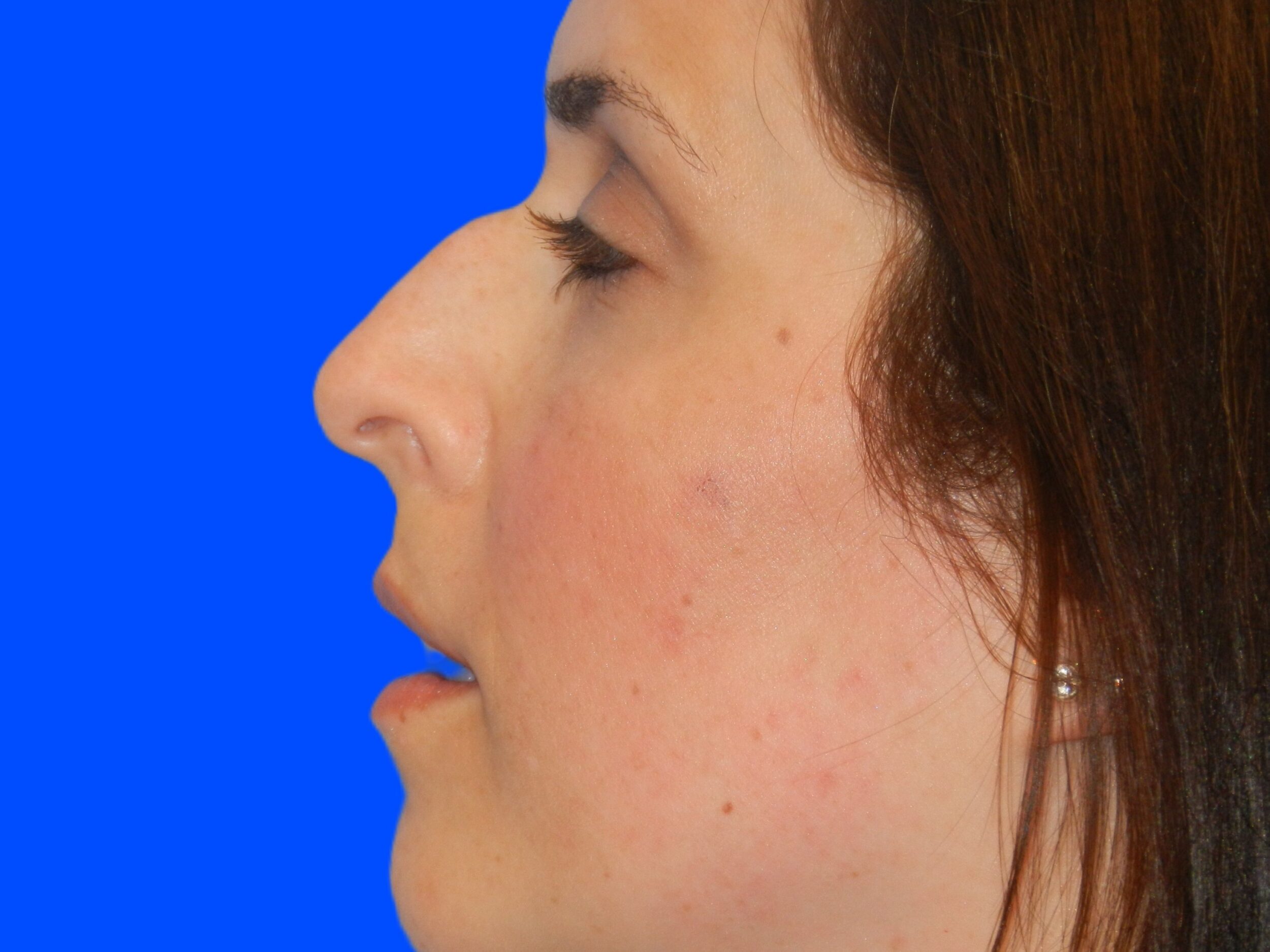 Before Image: Patient Case #1405 - left-side