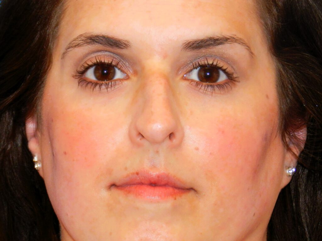 Before Image: Patient Case #1405 - front