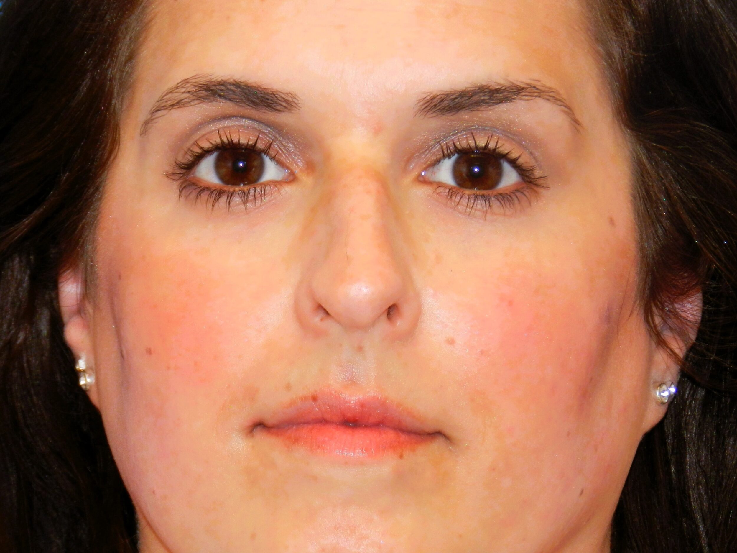 Before Image: Patient Case #1405 - front