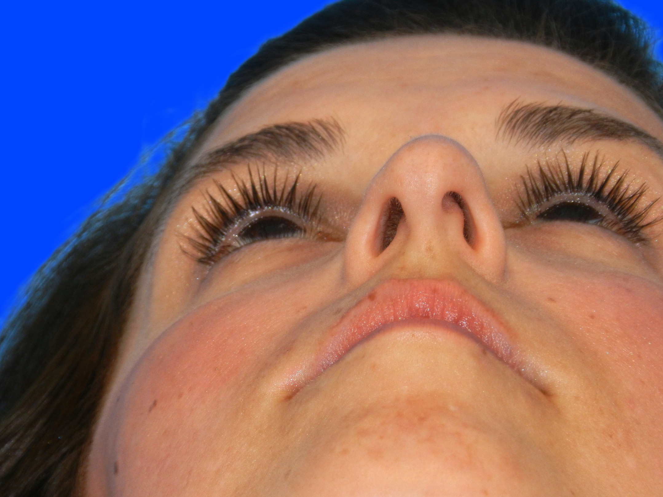 Before Image: Patient Case #1405 - front