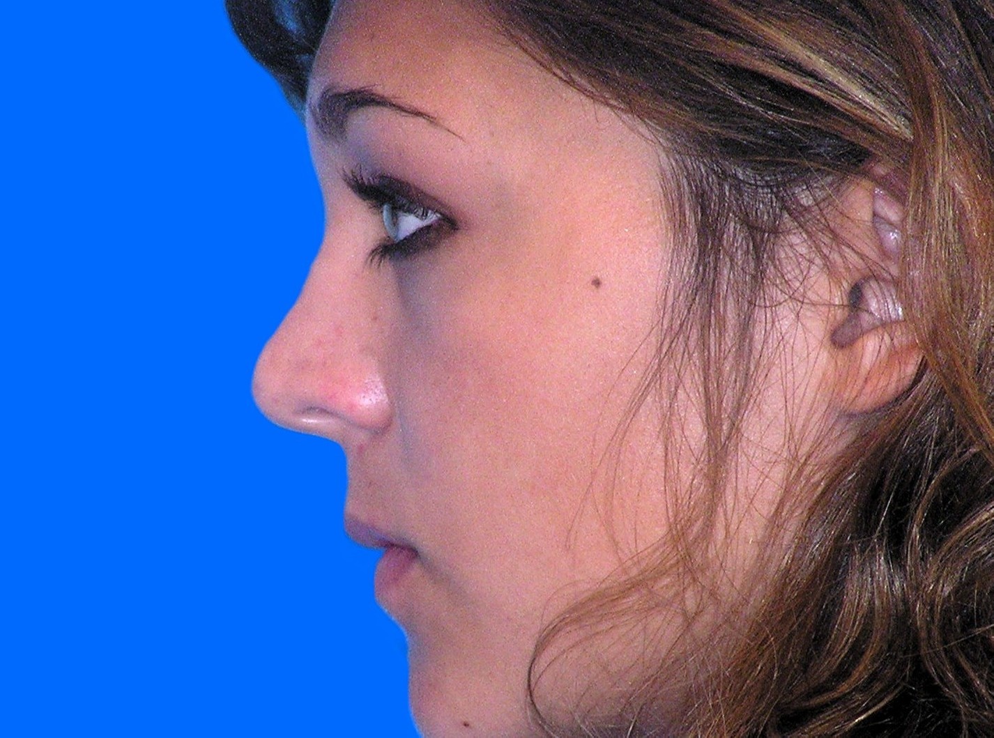 After Image: Patient Case #01406 - left-side