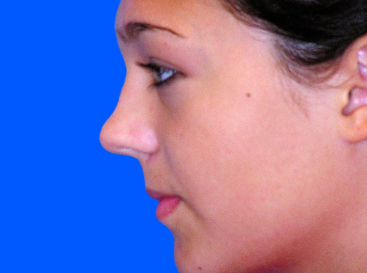 Before Image: Patient Case #01406 - left-side