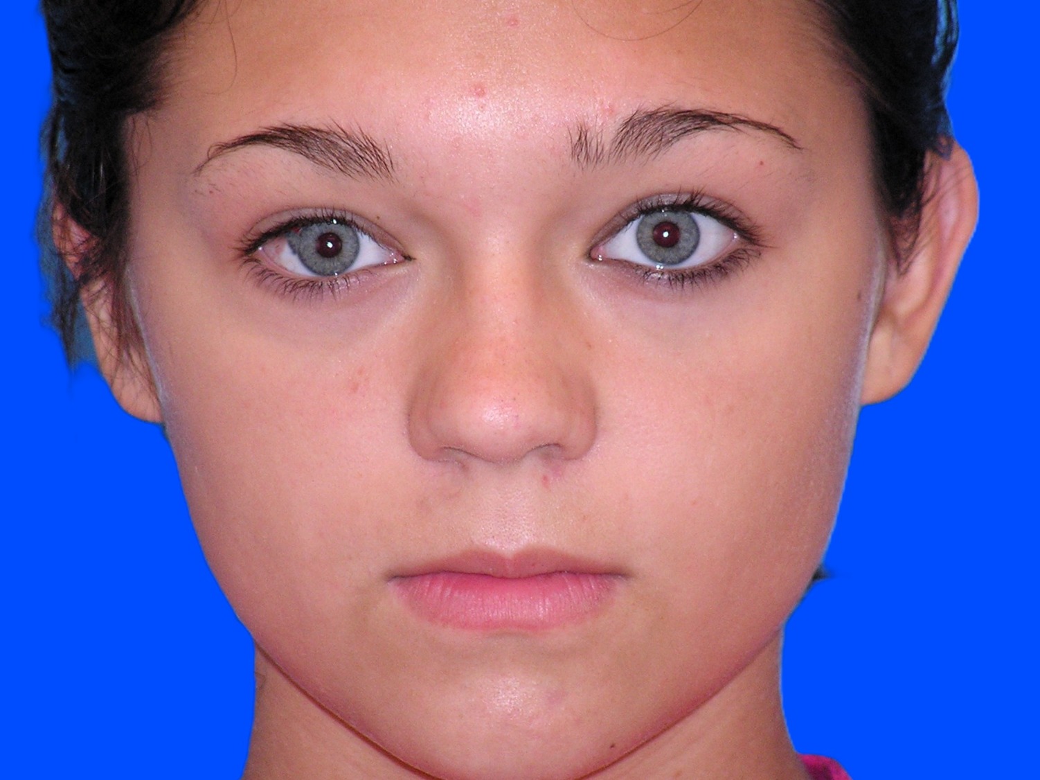 Before Image: Patient Case #01406 - front