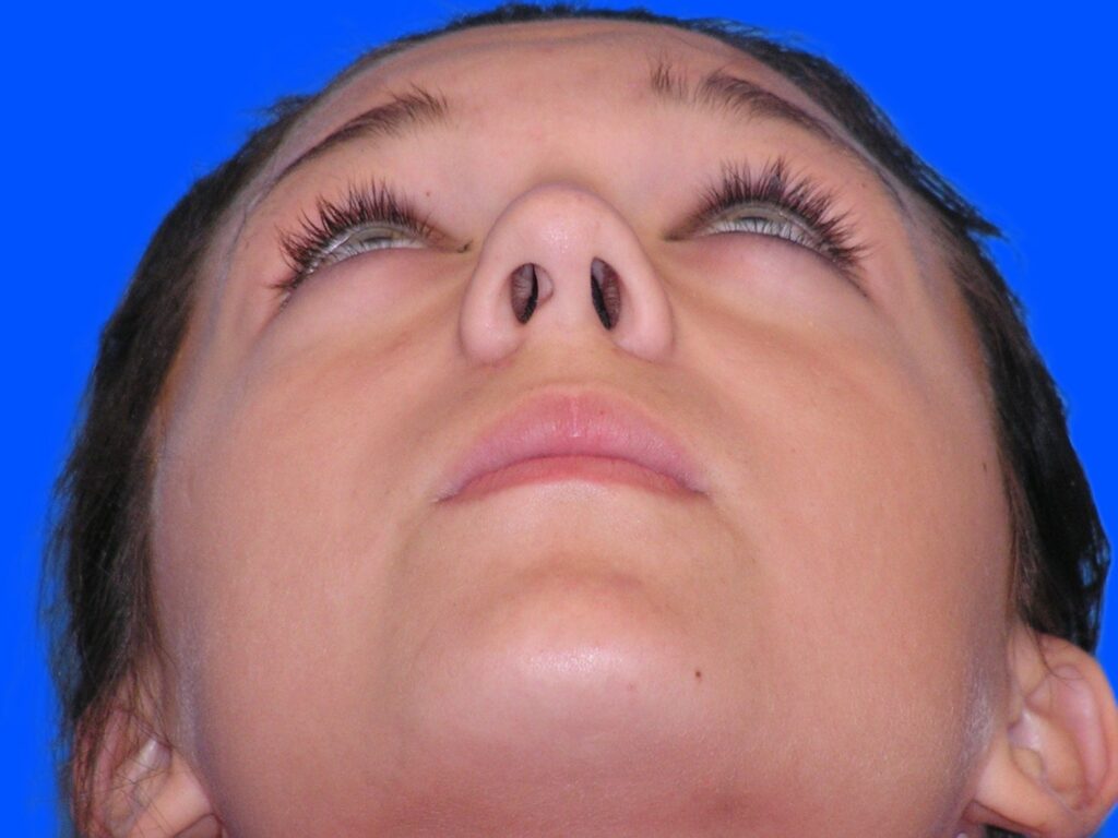 Before Image: Patient Case #01406 - front