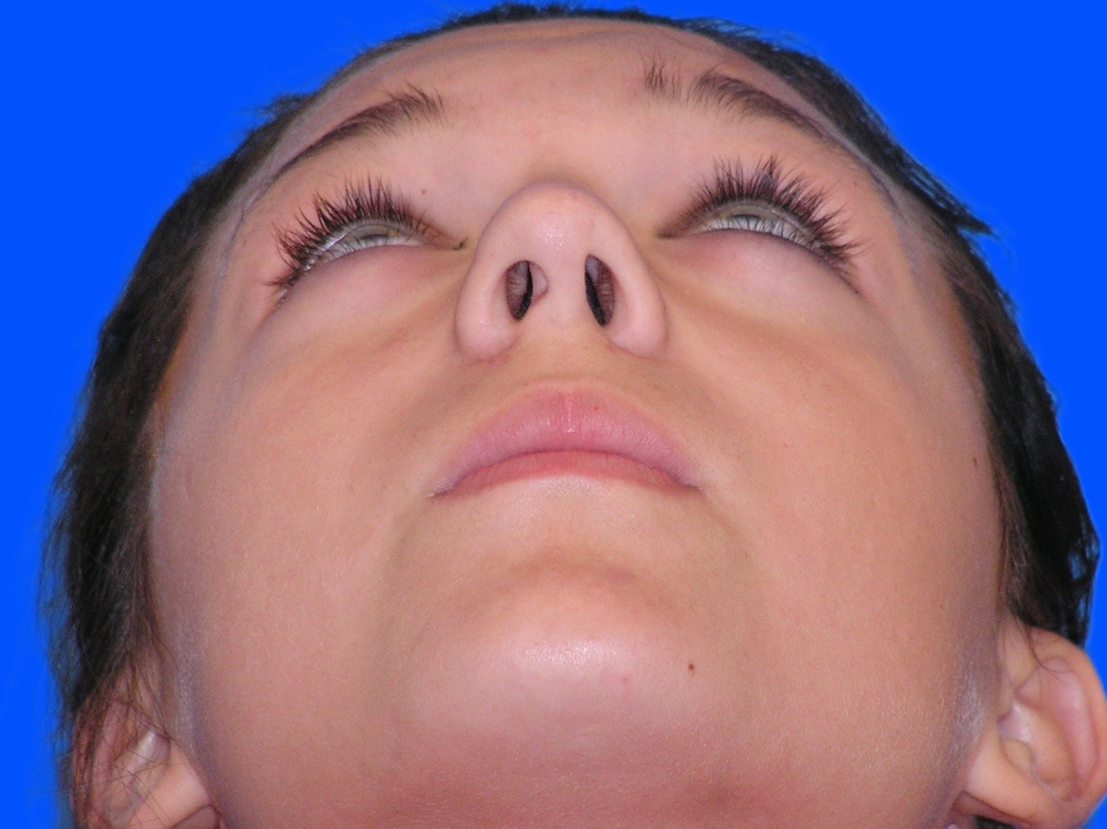 Before Image: Patient Case #01406 - front