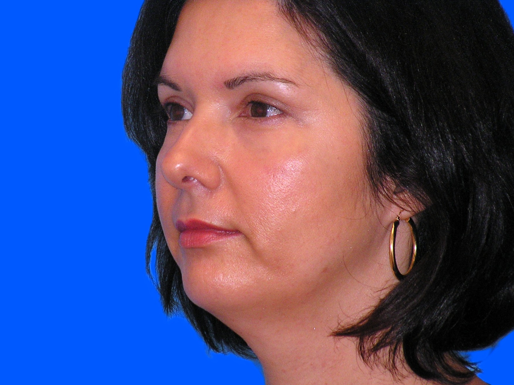 After Image: Patient Case #146 - left-front-oblique