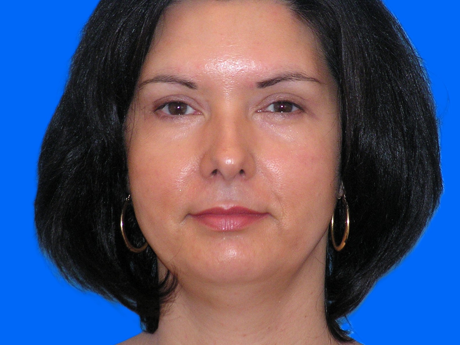 After Image: Patient Case #146 - front