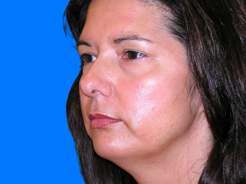 Before Image: Patient Case #146 - left-front-oblique