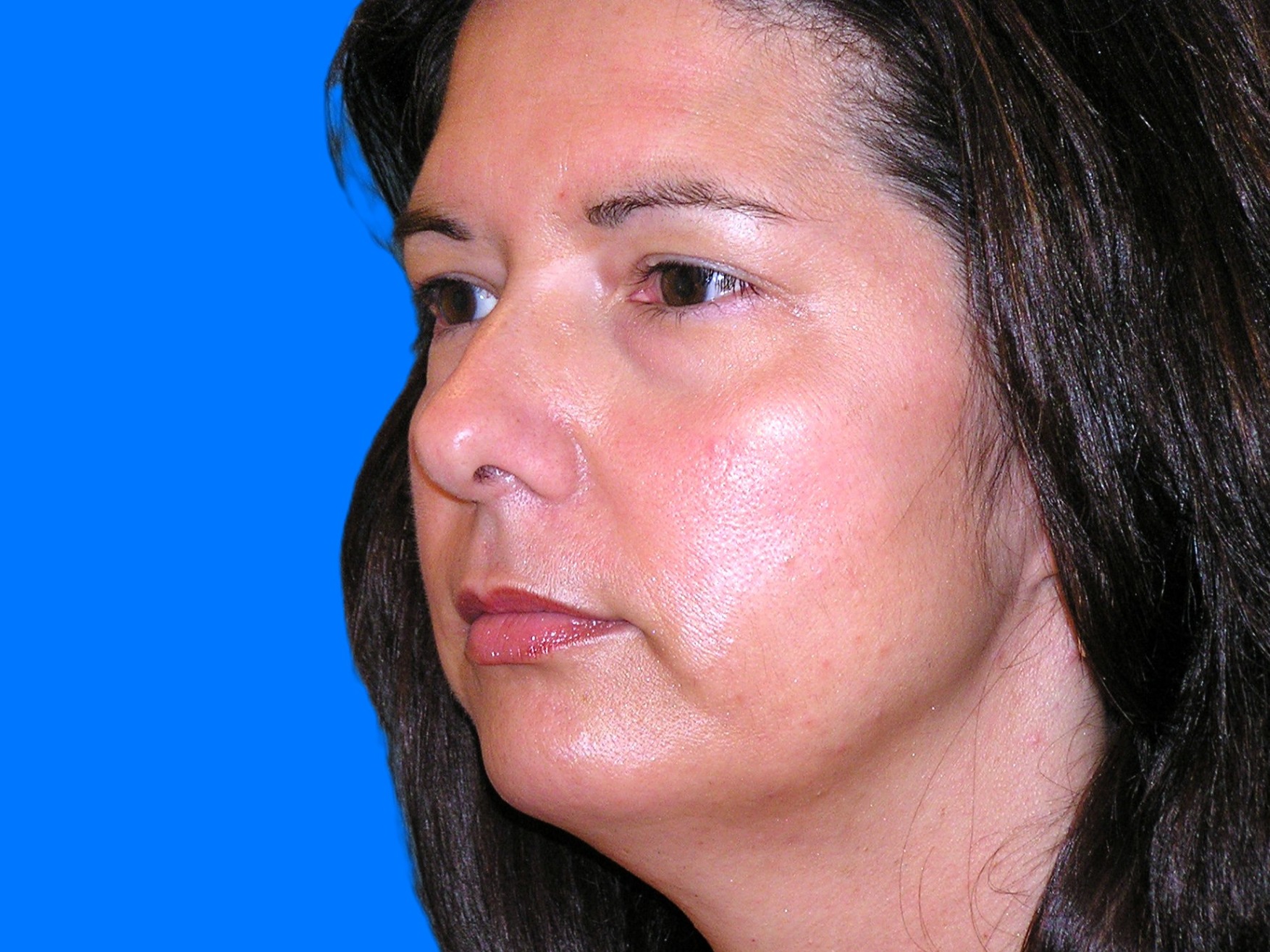 Before Image: Patient Case #146 - left-front-oblique