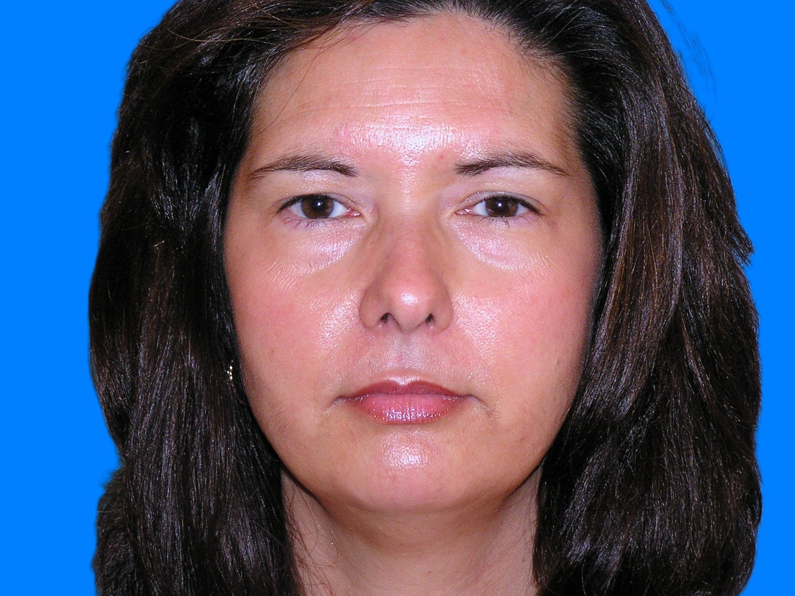 Before Image: Patient Case #146 - front