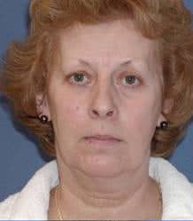 Before Image: Patient Case #147 - front