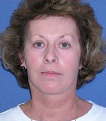 After Image: Patient Case #147 - front