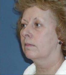 Before Image: Patient Case #147 - left-front-oblique