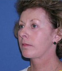 After Image: Patient Case #147 - left-front-oblique