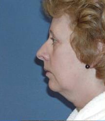 Before Image: Patient Case #147 - left-side