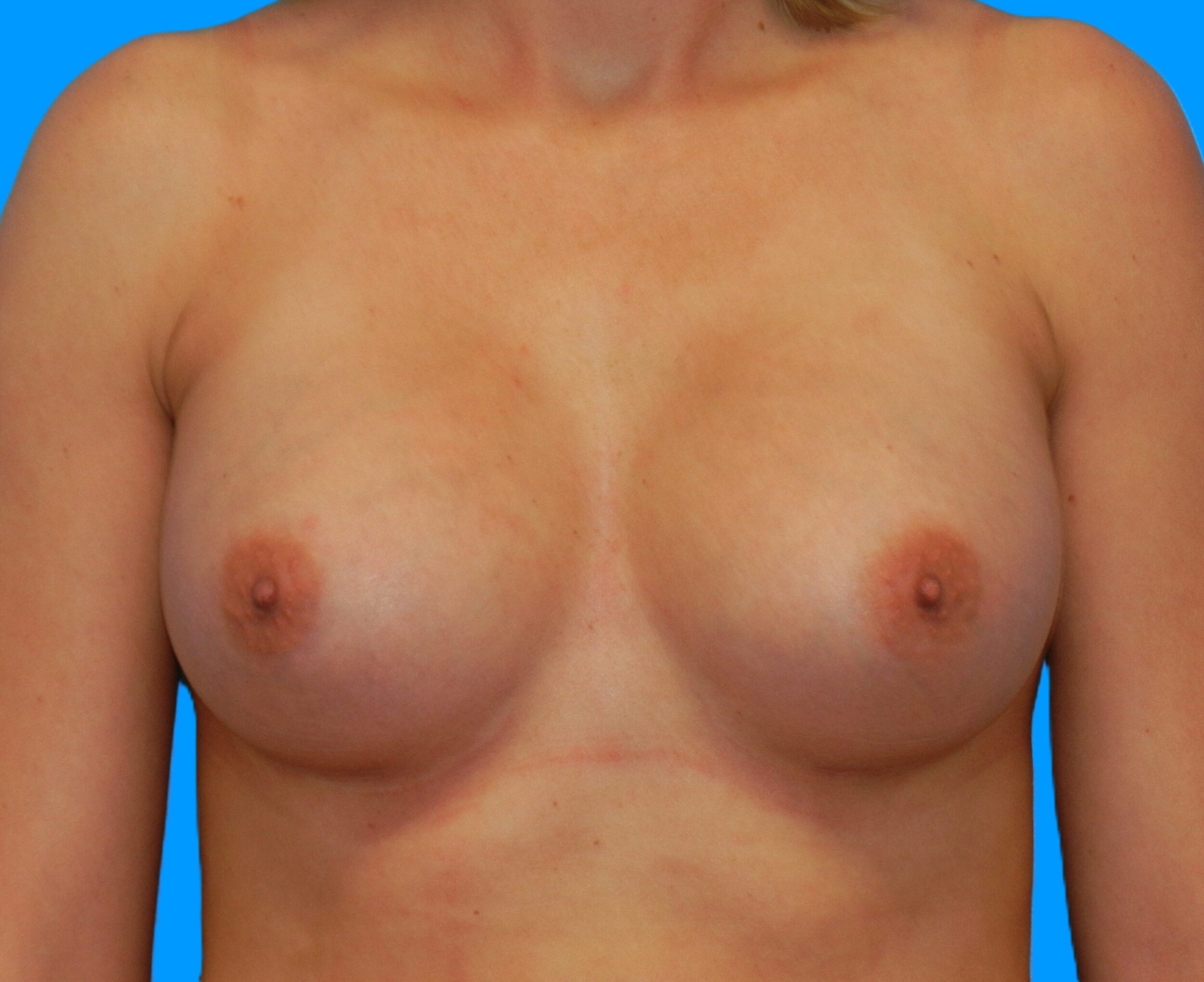 After Image: Patient Case #218 - front