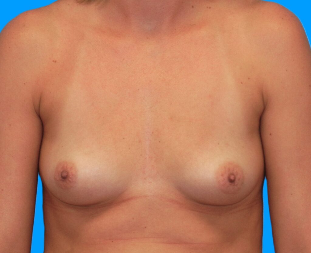 Before Image: Patient Case #218 - front