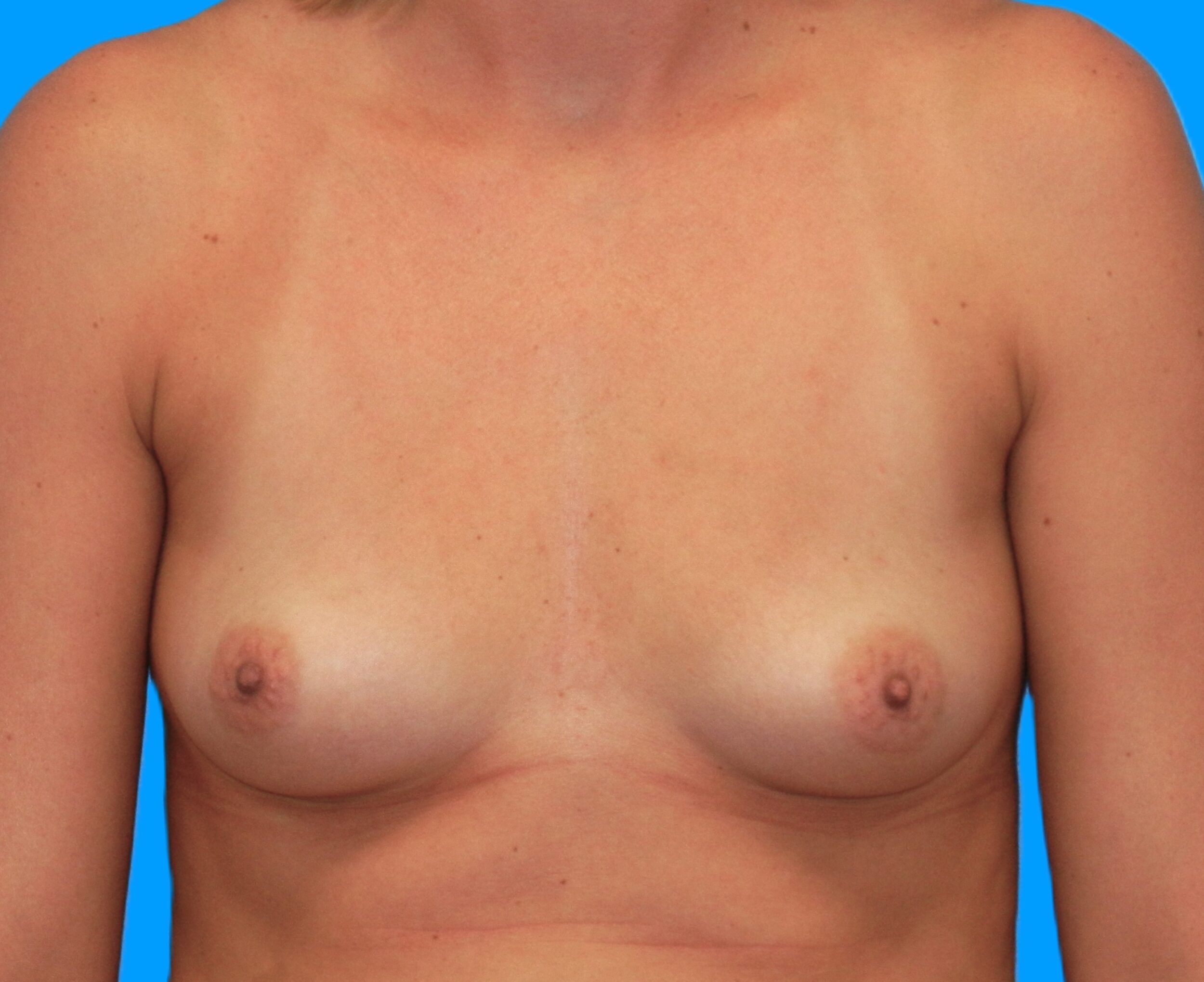 Before Image: Patient Case #218 - front