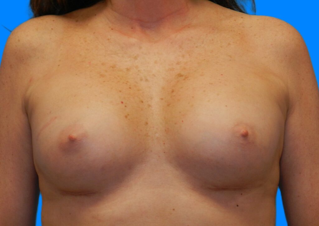 After Image: Patient Case #221 - front