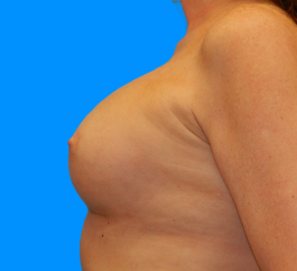 After Image: Patient Case #221 - left-side