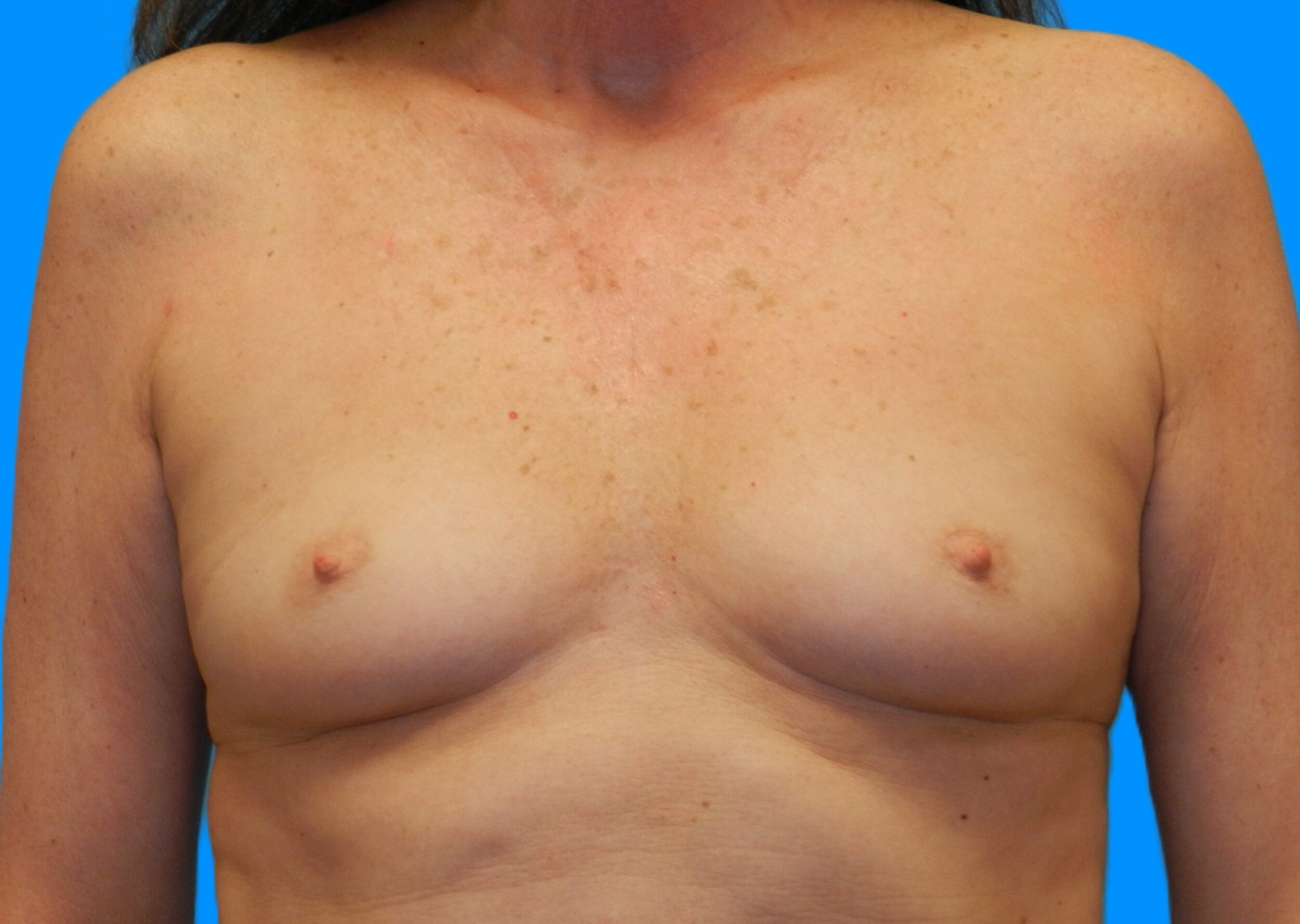 Before Image: Patient Case #221 - front