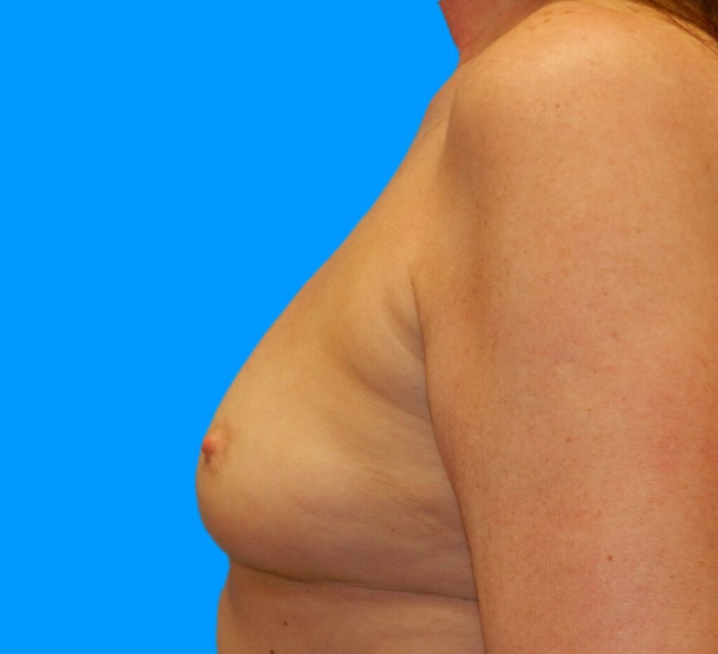Before Image: Patient Case #221 - left-side