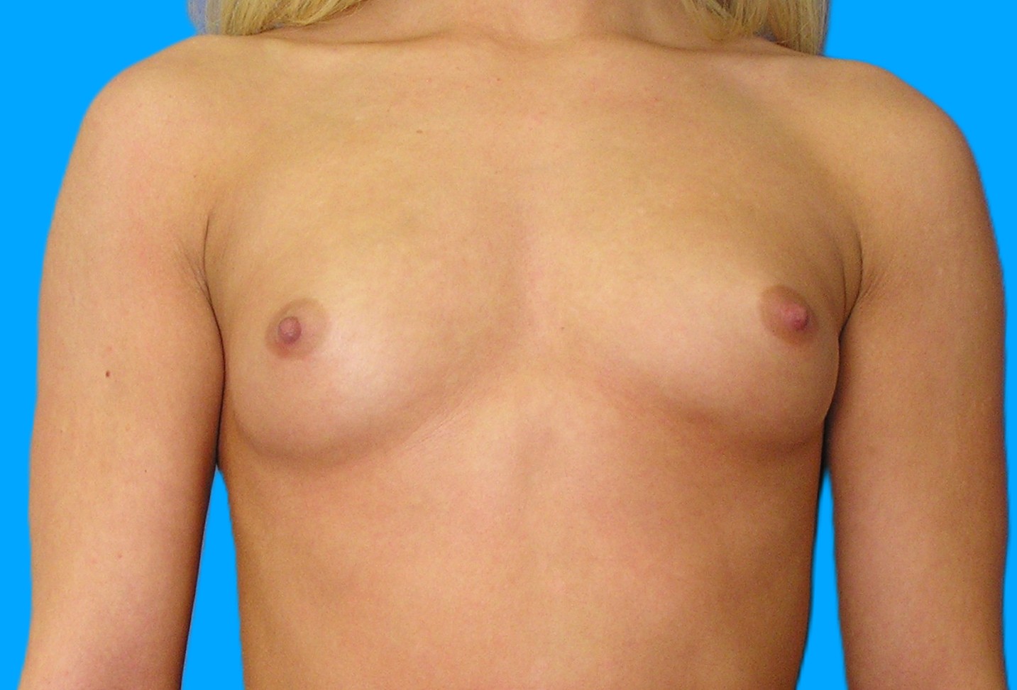 Before Image: Patient Case #252 - front