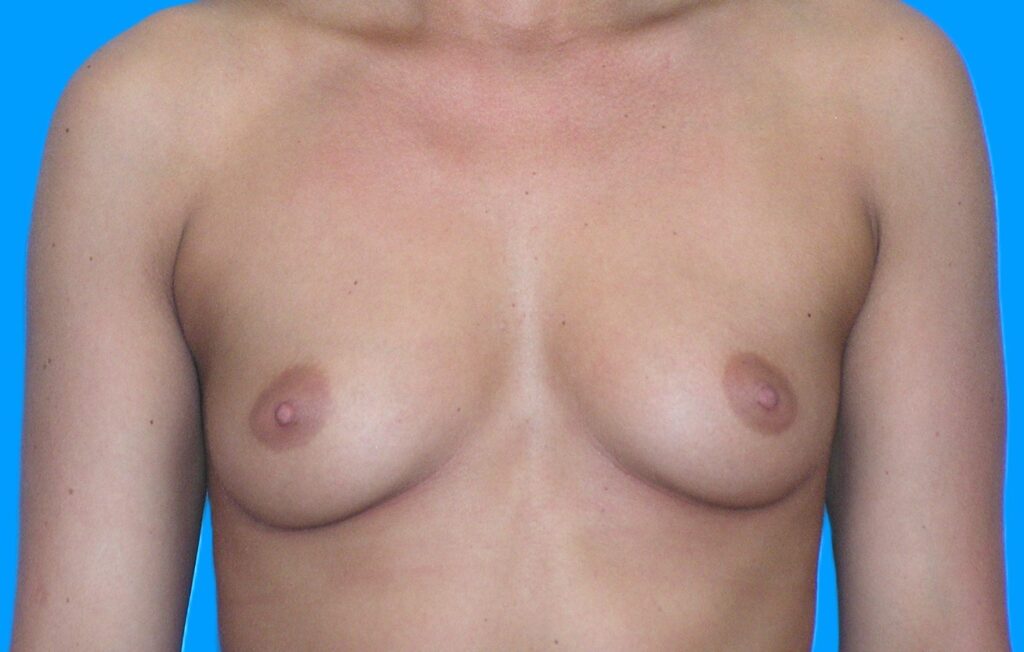 Before Image: Patient Case #255 - front
