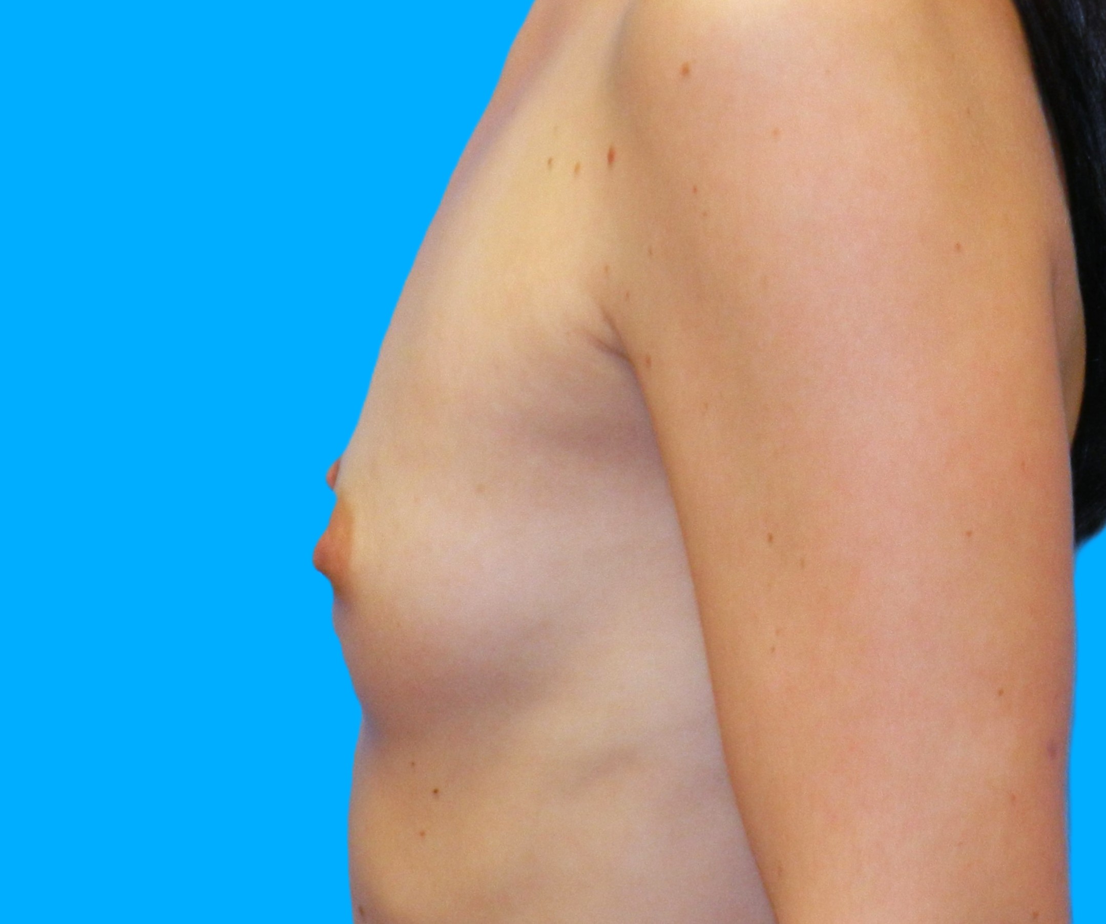 Before Image: Patient Case #257 - left-side