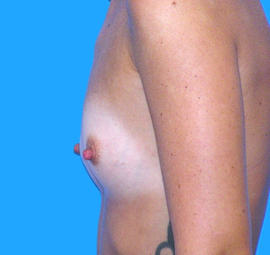 Before Image: Patient Case #258 - left-side