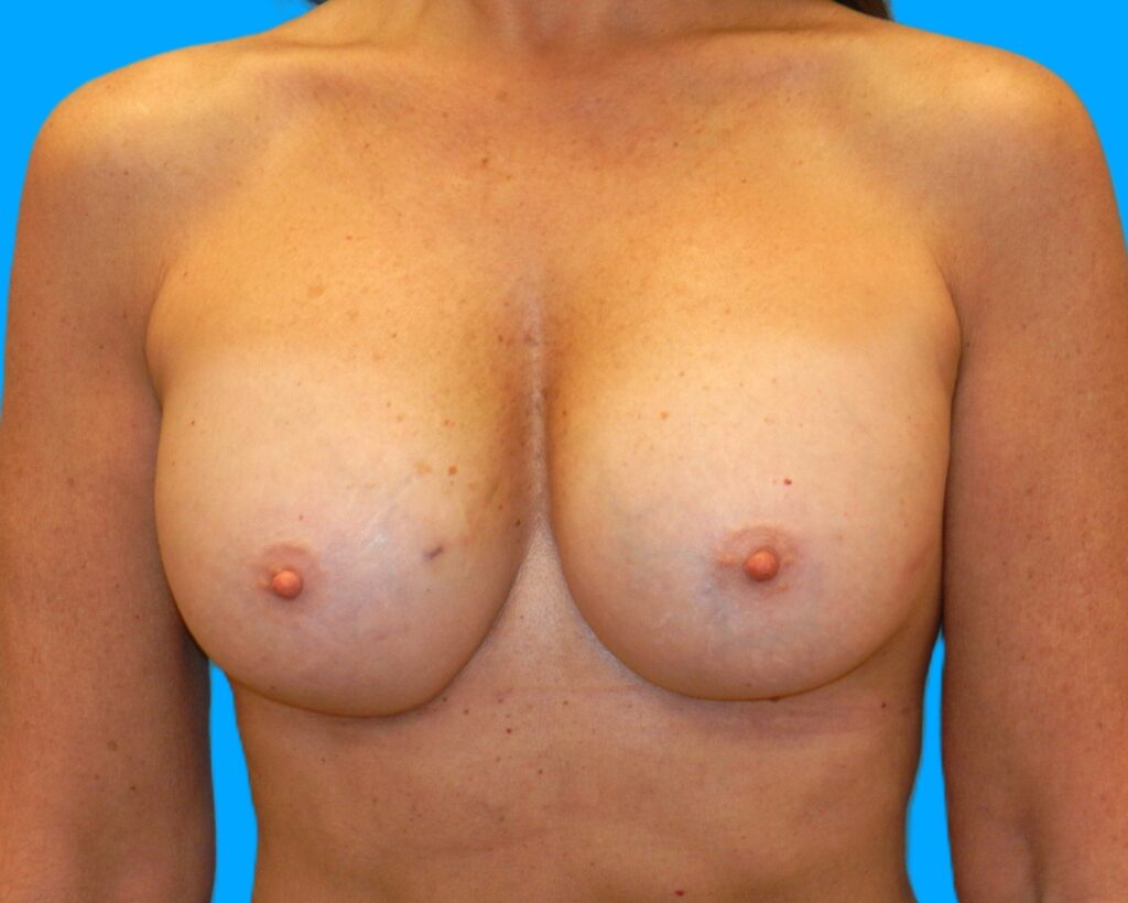 After Image: Patient Case #259 - front
