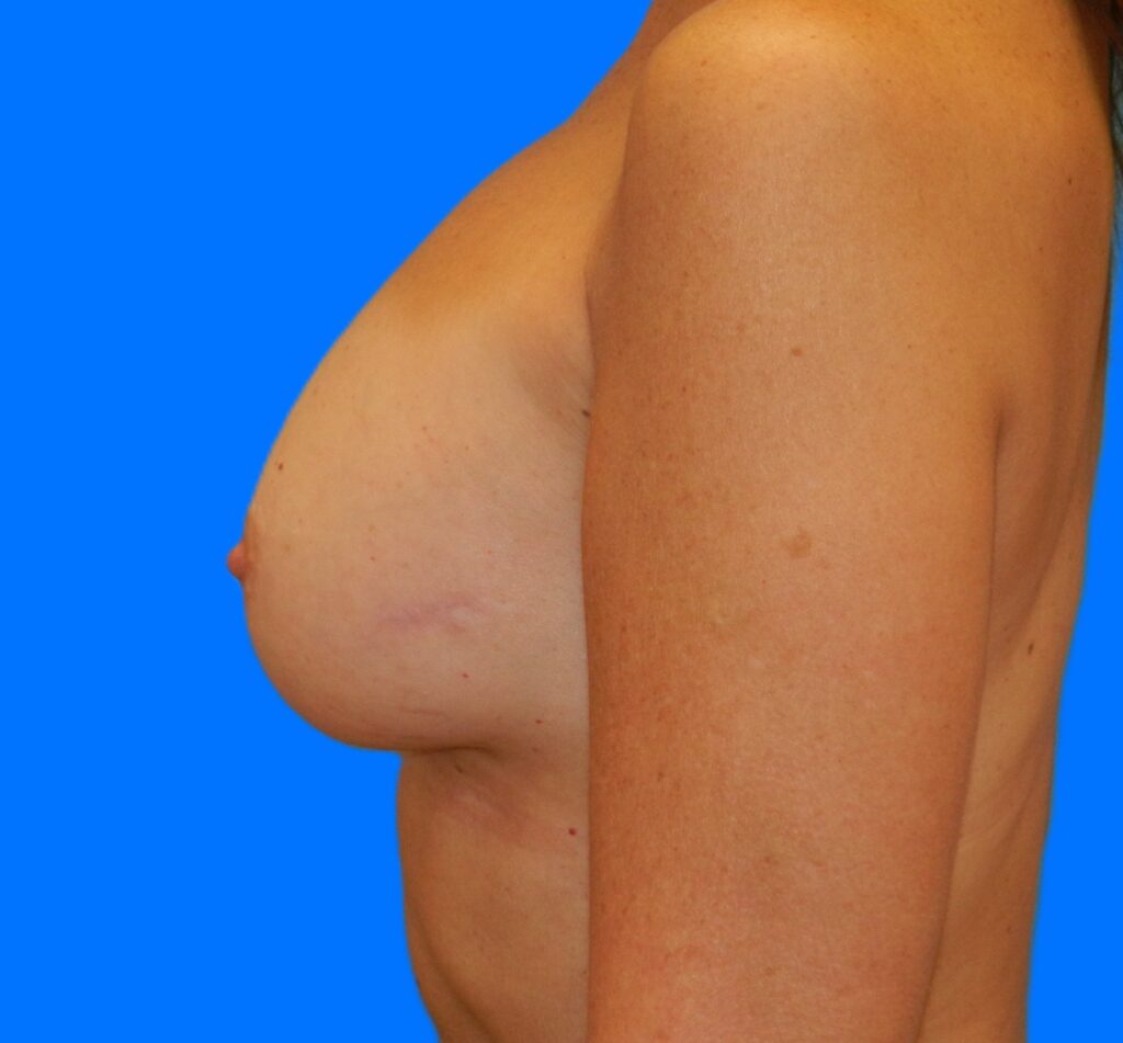 After Image: Patient Case #259 - left-side