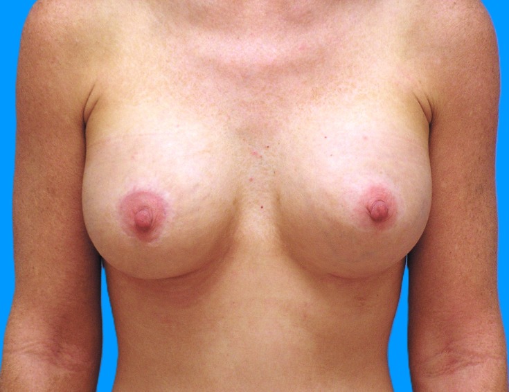 After Image: Patient Case #260 - front