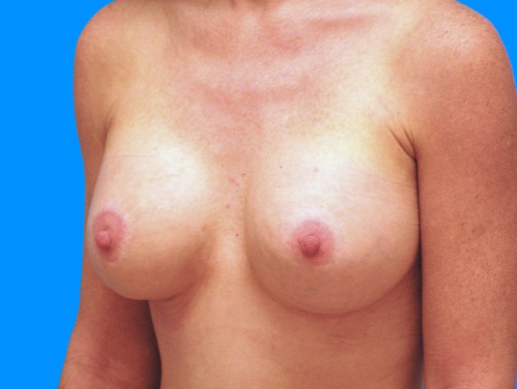 After Image: Patient Case #260 - left-front-oblique