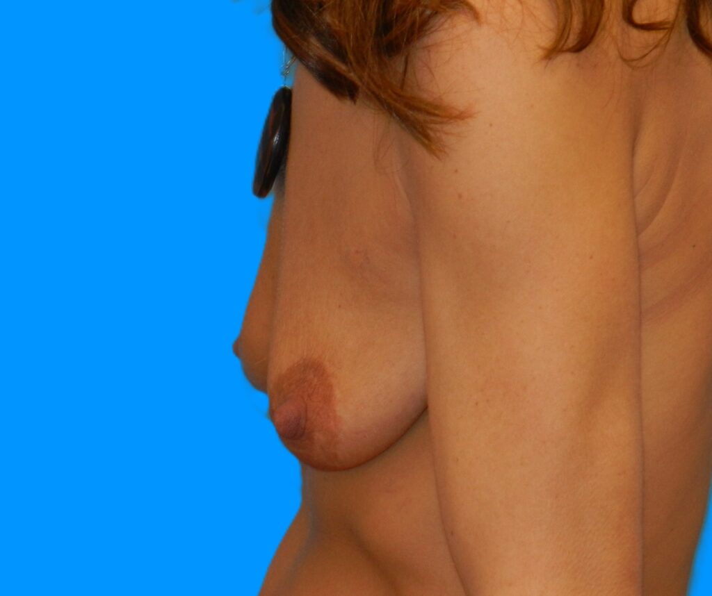 Before Image: Patient Case #261 - left-side