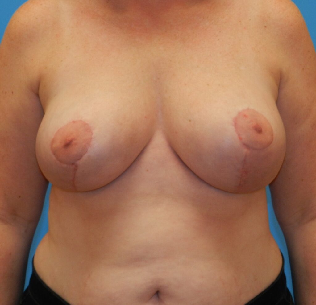 After Image: Patient Case #463 - front