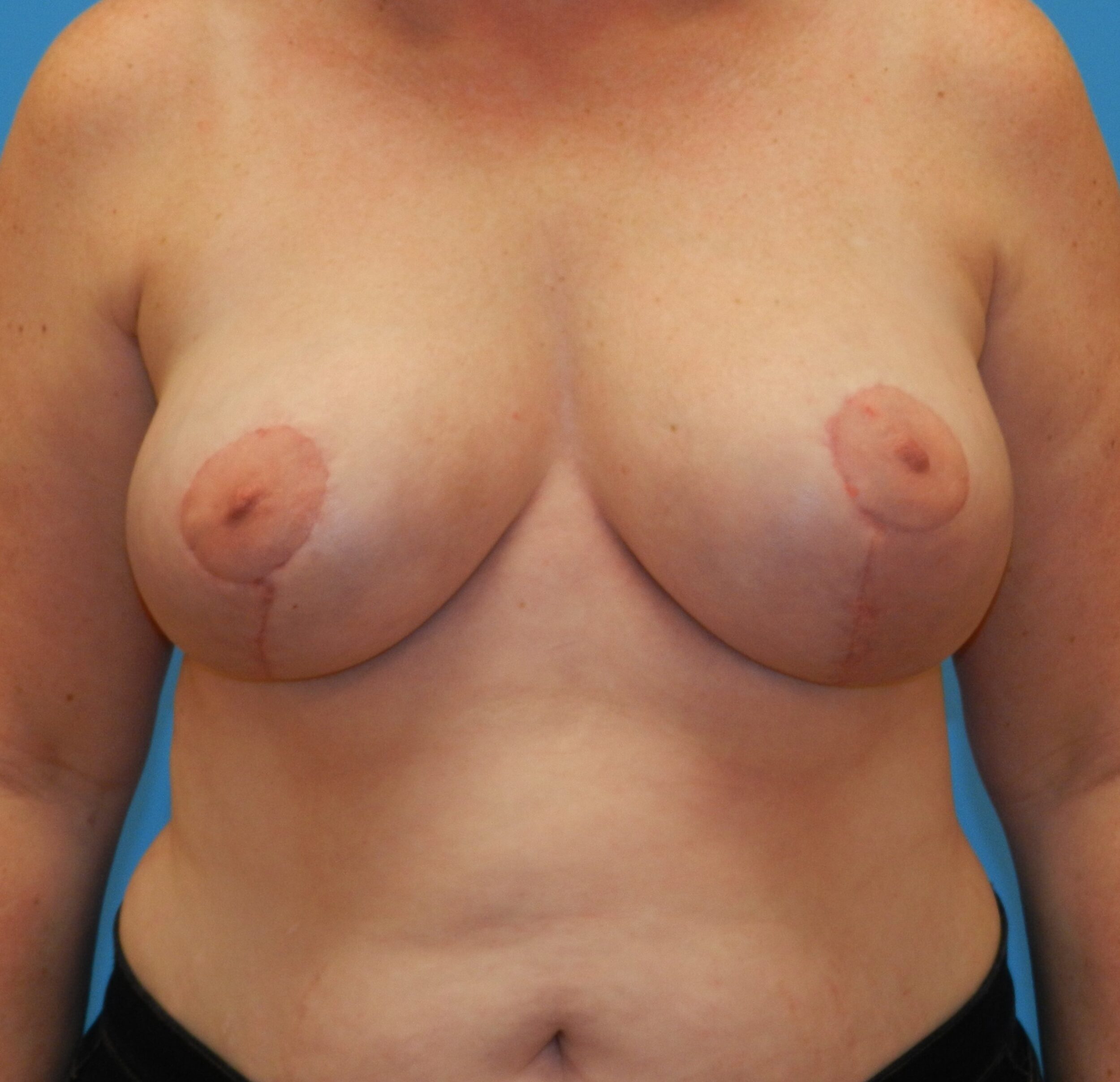 After Image: Patient Case #463 - front