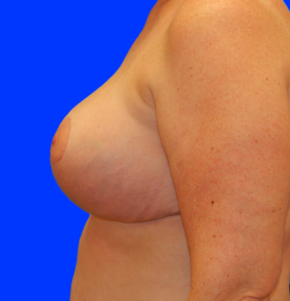 After Image: Patient Case #463 - left-side