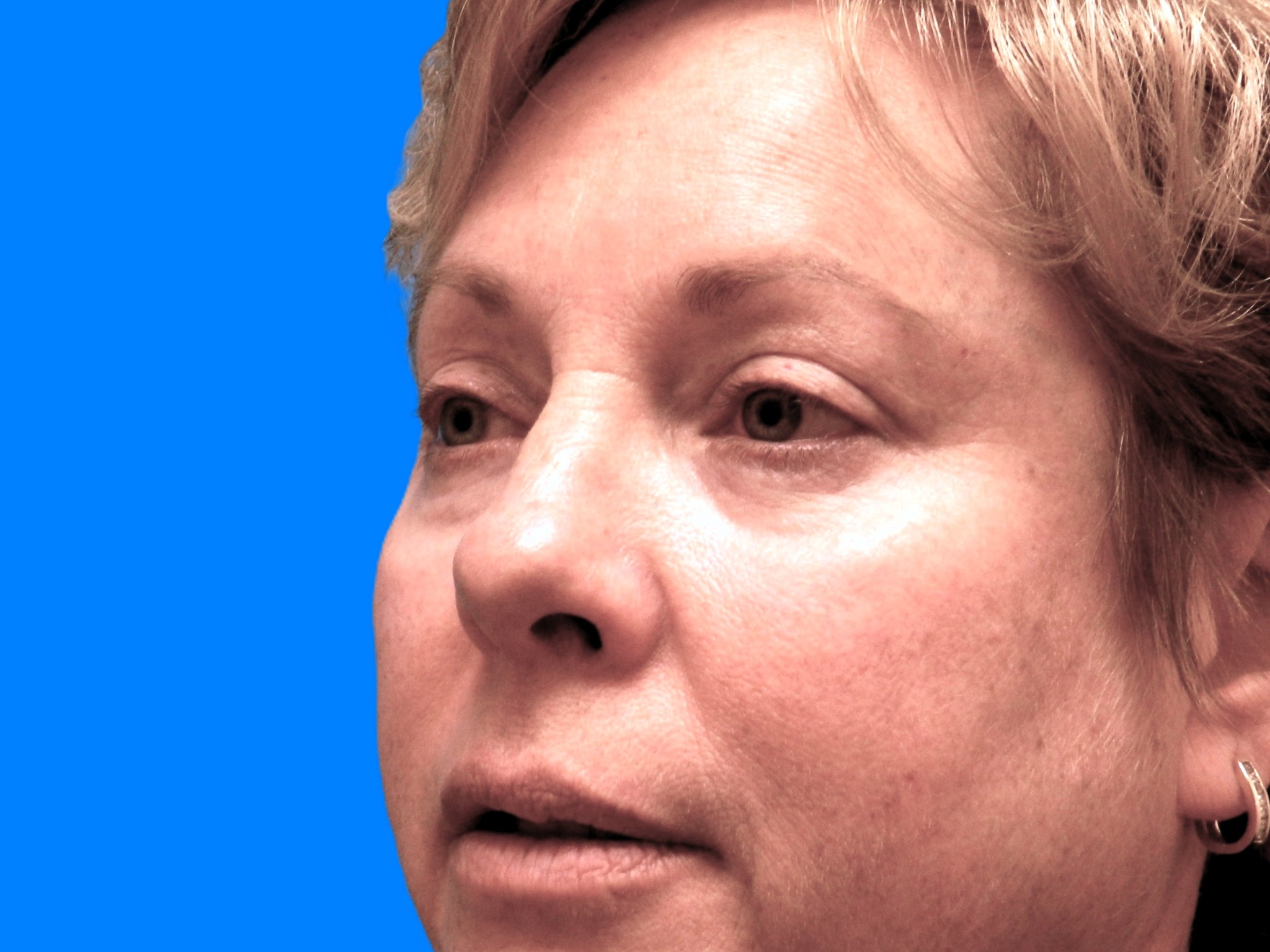 After Image: Patient Case #48 - left-front-oblique