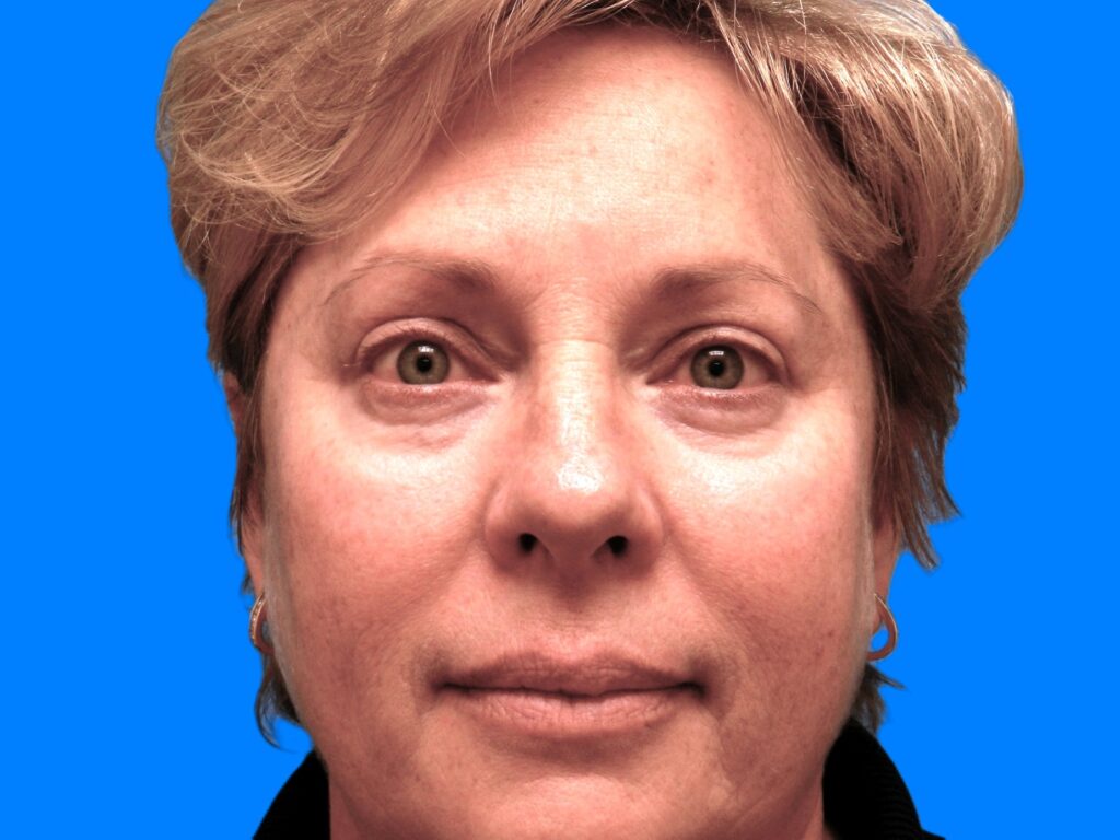 After Image: Patient Case #48 - front