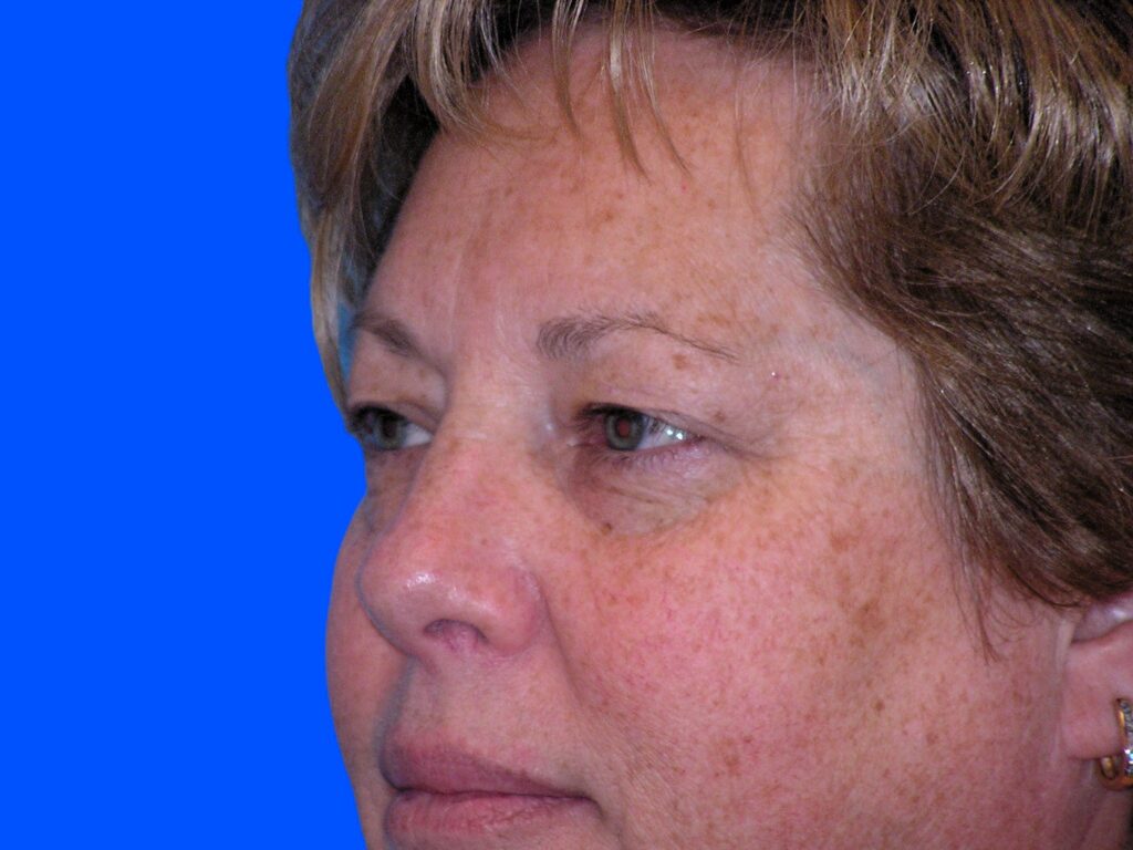 Before Image: Patient Case #48 - left-front-oblique