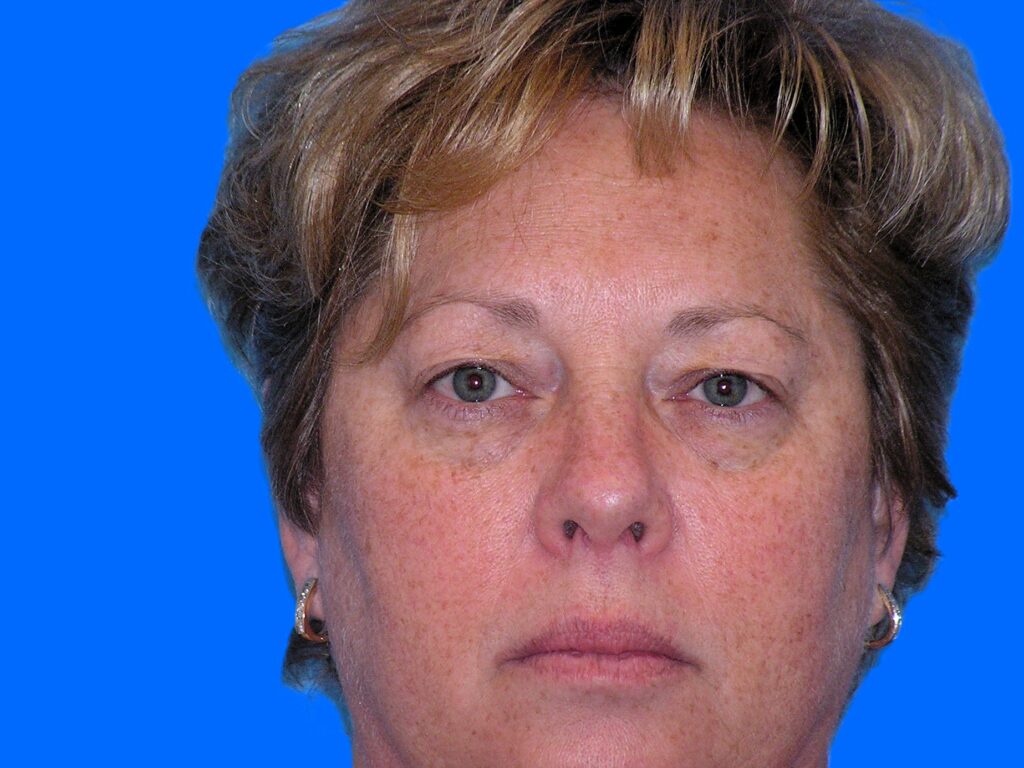 Before Image: Patient Case #48 - front