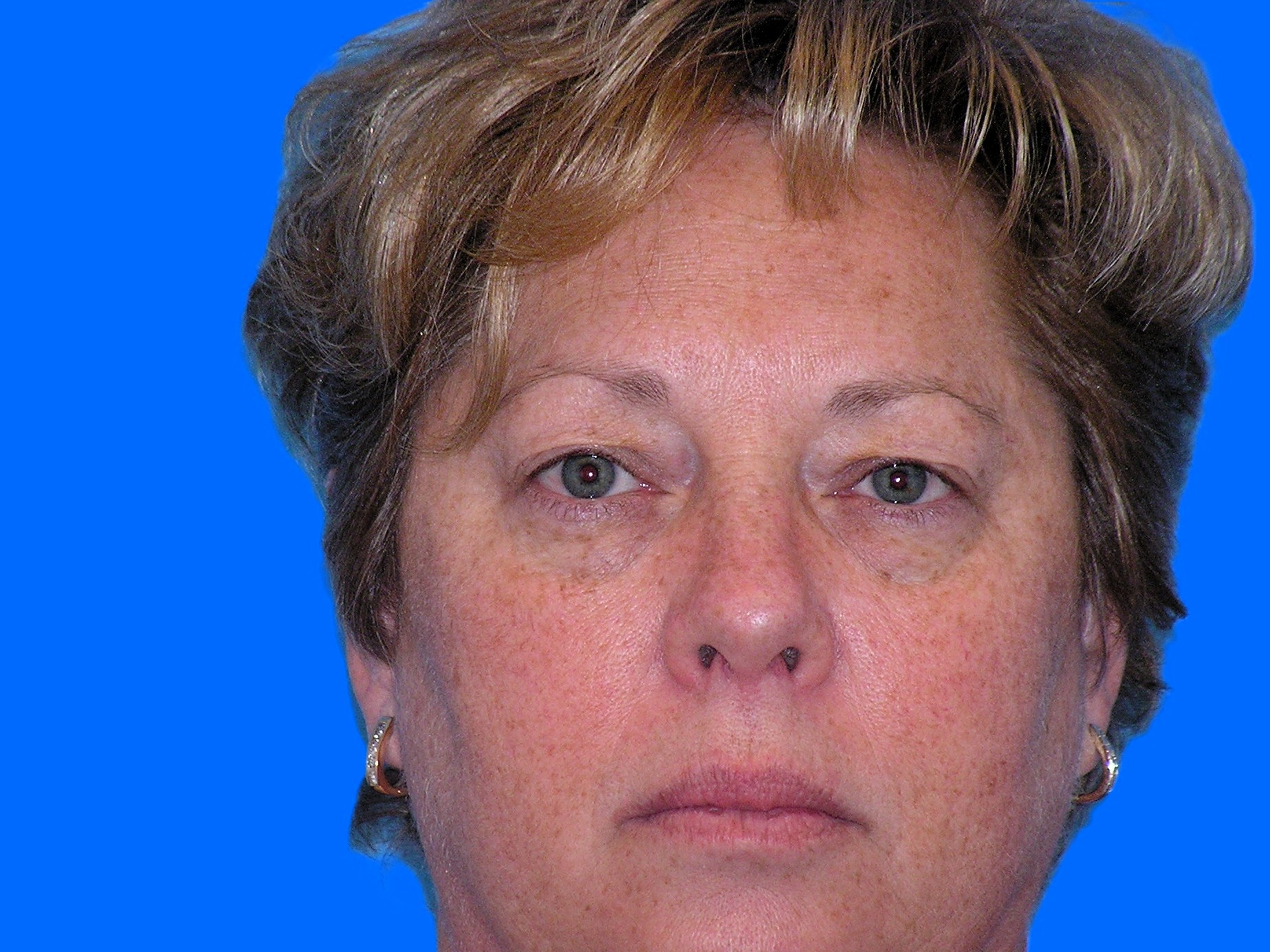 Before Image: Patient Case #48 - front